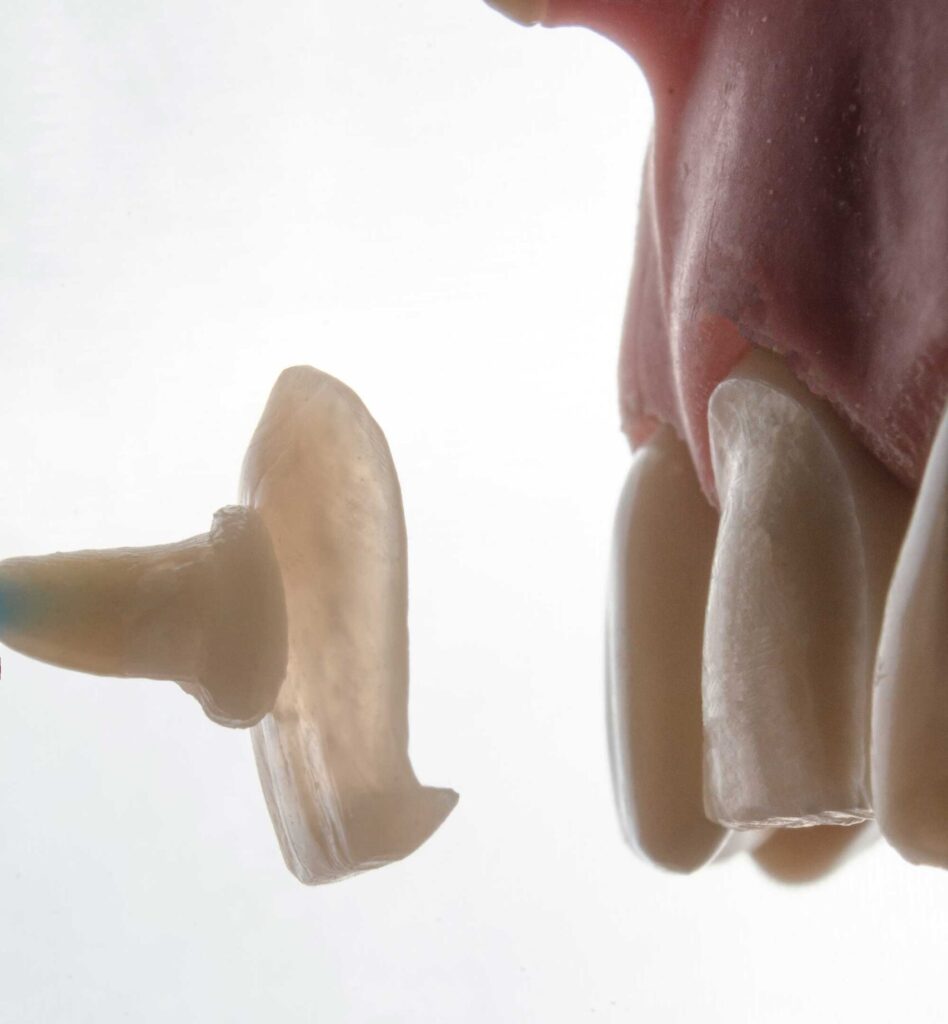 Faccette-estetiche Studio Odontoiatrico Massotti